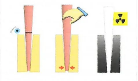 Figure 6 : Tests visuel, tactile et radiographique d’adaptation du maitre-cône de gutta-percha