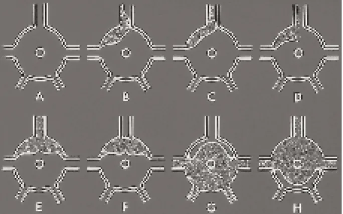 Fig. 4. Comment la dissection aortique peut provoquer l’insuffisance valvulaire aortique aiguë : par déplacement d’une valve sous l’effet de la dissection (2), par la destruction de la zone d’insertion d’une valve (3), par la dilatation globale de l’annulu