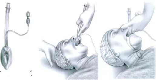 Figure   7:   Insertion   et   mise   en   place   d'un   masque   laryngé   (17)   