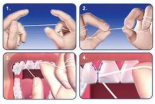 Figure 6 : Les différentes étapes pour l’utilisation du fil dentaire