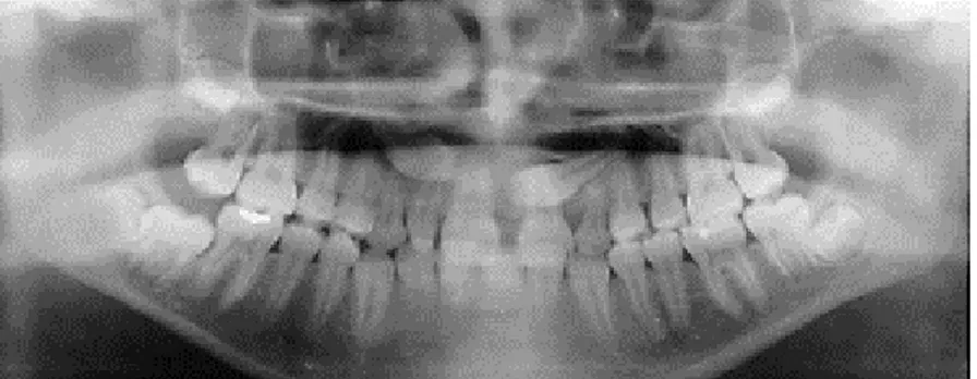 Fig. 1.6. Radiographie panoramique d’une patiente de 14 ans atteinte d’agénésie de la 22 avec canines maxillaires permanentes incluses et microdontie de la 12 (Pinho, 2011).