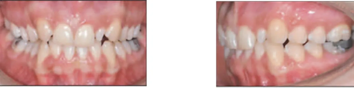 Fig. 1.8 et 1.9. Patiente atteinte d’agénésie unilatérale de la 12 et incisive controlatérale (22) riziforme (Bonnin, 2012).