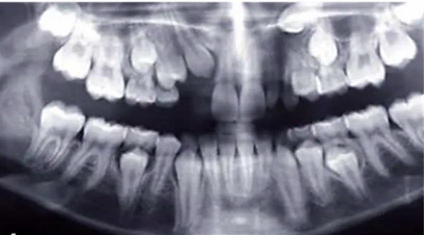 Fig. 1.12. Radiographie panoramique d’une patiente présentant une agénésie de la 12, une microdontie de la 22 et 13 et 23 incluses (Seyed Movaghar et al., 2011).