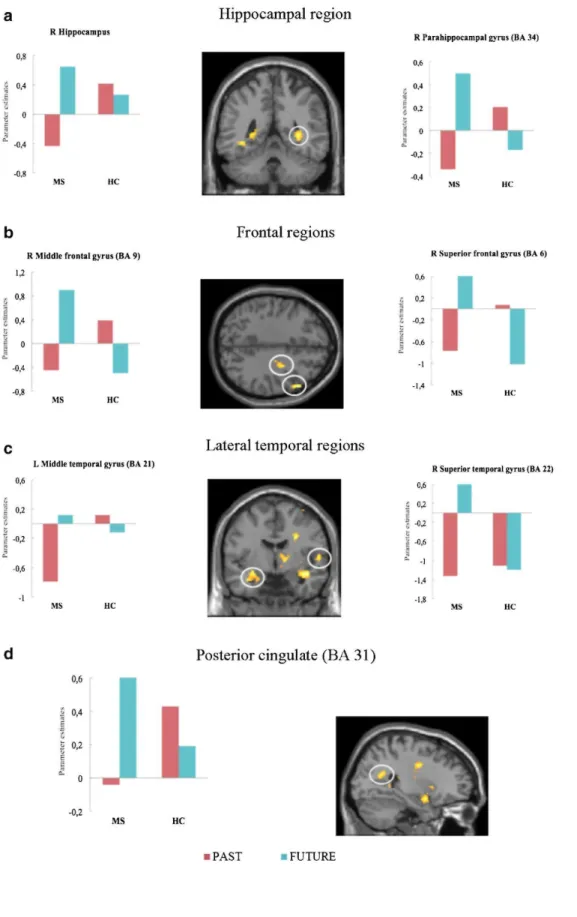 Fig. 4  Significant brain activations for the Group x Task interaction in the right hippocampus and right  parahippocampal gyrus (BA 34), the right middle (BA 9) and superior (BA 6) frontal gyri, the left middle (BA  21) and right superior (BA 22) temporal