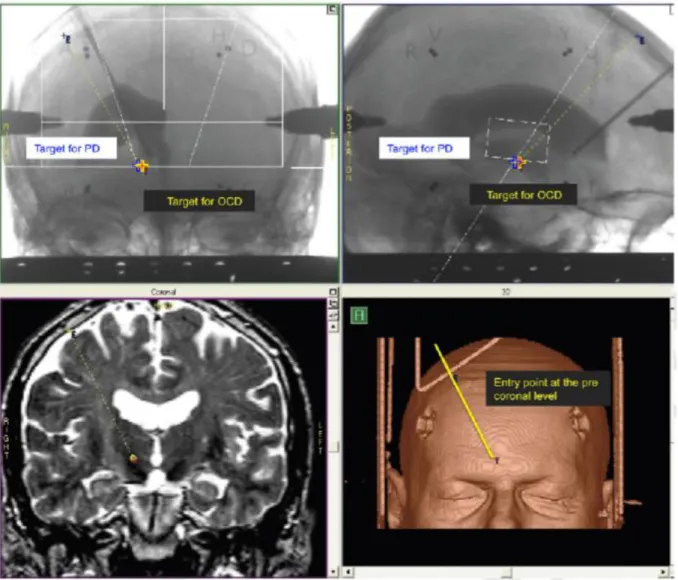 Figure 3 : Exemple de repérage visuo-spatial avant l’implantation d’électrodes. 