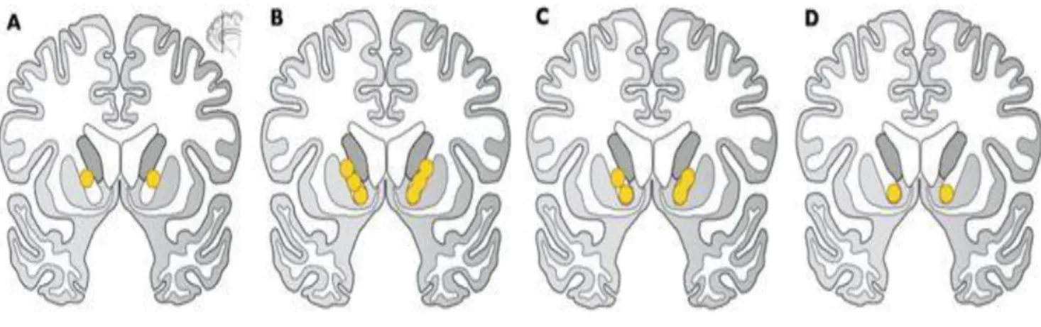 Figure 5 : Cibles de la neurochirurgie dans le TOC. (68) 