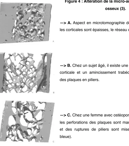 Figure 4 : Altération de la micro-architecture  du tissu  osseux (3).