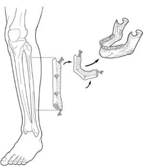 Figure 15 : Principe du lambeau libre fibulaire (Facial Plastic, Reconstructive, and Trauma  Surgery, Robert W.DOLAN) 