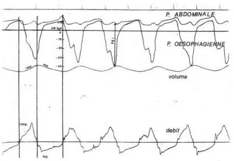 Figure 1. Mécanique ventilatoire chez un nourrisson atteint de bronchiolite, 