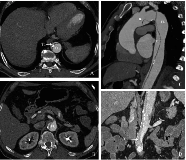 Figure 1: 71-years-old patient admitted for acute type B AD with severe bowel ischemia due  to  dynamic  compression