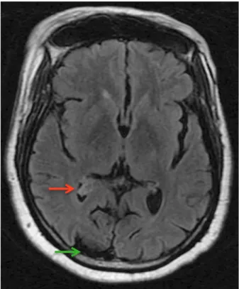 Figure 8 – Patient p3 : IRM cérébrale séquence T2-FLAIR  en  coupe  axiale  retrouvant  une  dilatation  du  plexus  choroïde  droit  (flèche  rouge)  et  une  atrophie  occipitale  droite (flèche verte) 