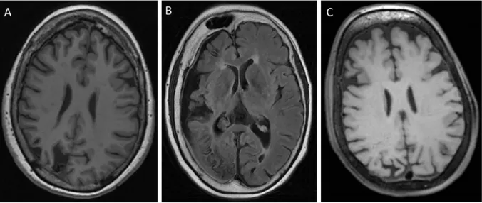 Figure 9 – IRM cérébrale en séquence T1 non injecté en coupe axiale retrouvant une atrophie cérébrale