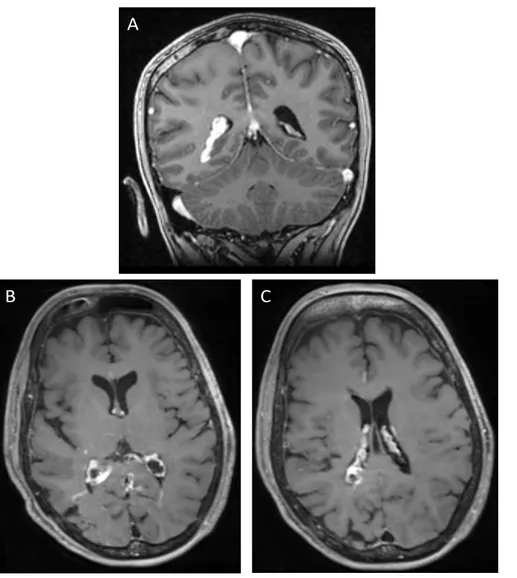 Figure  11  –  IRM  cérébrale  en  séquence  T1  injectée  en  coupe  coronale  (A)  et  axiale  (B  et  C)