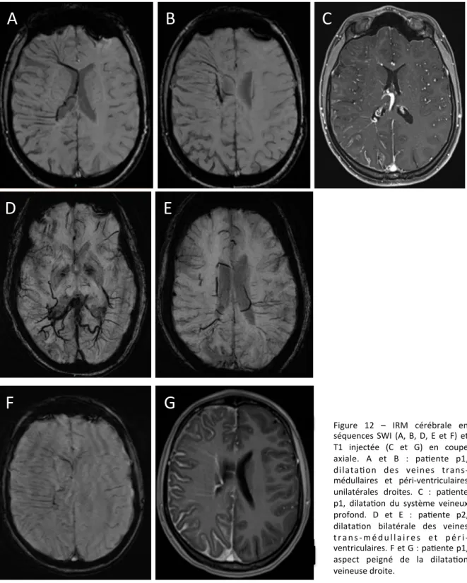 Figure  12  –  IRM  cérébrale  en  séquences  SWI  (A,  B,  D,  E  et  F)  et  T1  injectée  (C  et  G)  en  coupe  axiale