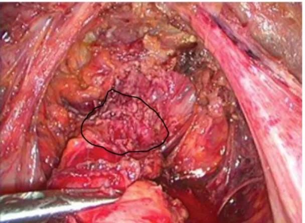 Figure 12.0 : Vue coelioscopique : Shaving rectal (nodule  d͛endométriose contouré) puis excision emportant la  partie postérieure du torus et une pastille vaginale