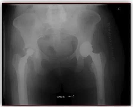 Figure   27   :   Mauvais   positionnement   de   l’implant   acétabulaire   induisant   une   instabilité   chronique