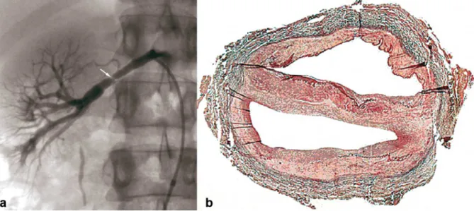 Figure 1. Example of intimal FMD lesions. 