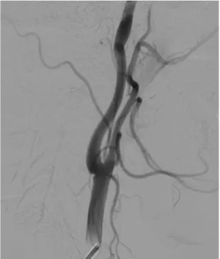 Figure 4. Radiologic findings in a 39 year old female patient, presenting with non traumatic spontaneous  subarachnoid hemorrhage