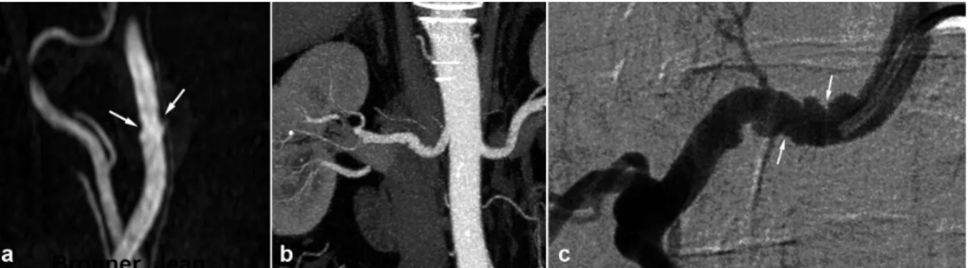Figure 6. Radiologic findings in a 62 year old male patient with arterial hypertension