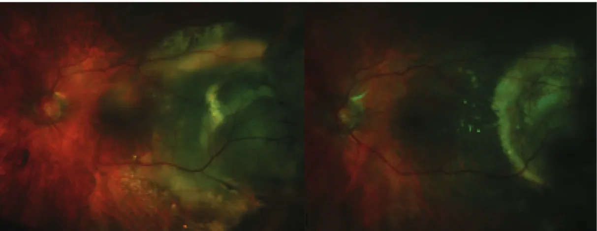 Figure 2 : Œil gauche du même patient : avant traitement (image de gauche),  puis après 3 injections intra vitréennes de ranibizumab (image de droite)