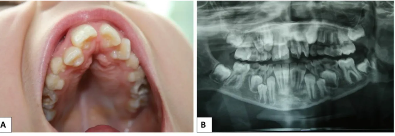 Figure 14: Aspect oro-dentaires dans le SRT. 
