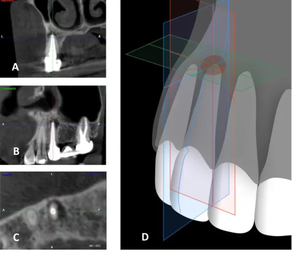 Figure 12 : Cas clinique numéro 10, dent 25, positionnement des plans de coupe au CBCT pré- pré-opératoire 
