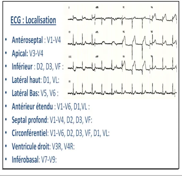 Figure 3 : Différents territoire ECG (adapté de P. Taboulet e-cardiogram) 