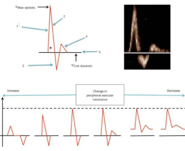 Figure  2 :  Flux  artériel  périphérique  normal  et  évolution  en  fonction  des  résistances  périphériques 