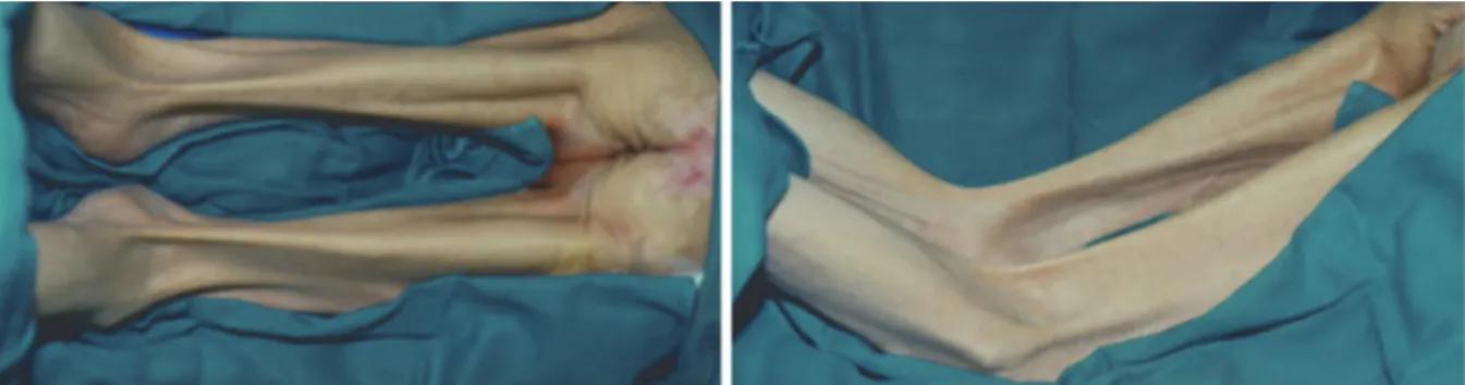 Figure 7 : Patient neuro lésé présentant des rétractions tendineuses des muscles ischio jambiers