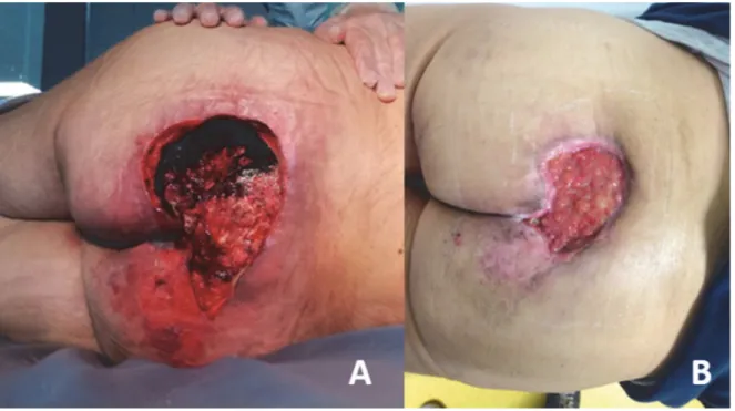 Figure 11 : Escarre sacrée : après parage (A) et après plusieurs mois de cicatrisation dirigée (B)