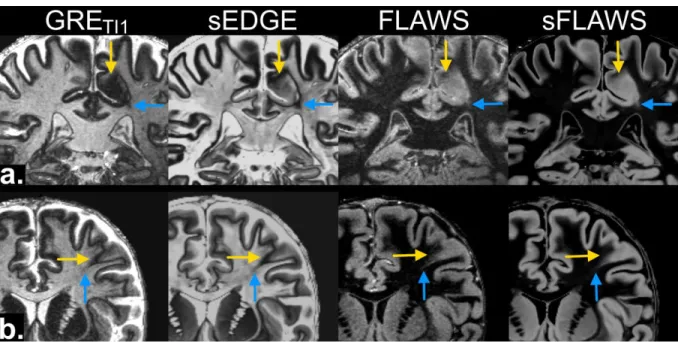 Figure  6  shows  individual  cases  where  synthetic  images  were  considered  slightly  inferior than their original counterparts for lesion depiction