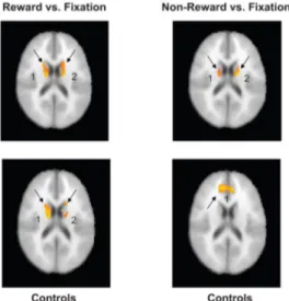Fig. 12 : Activation cérébrales des patients TDAH par rapport aux contrôles, pendant la récompense à  la suite d’une tâche réussie et en cas de tâche non-récompensée réussie