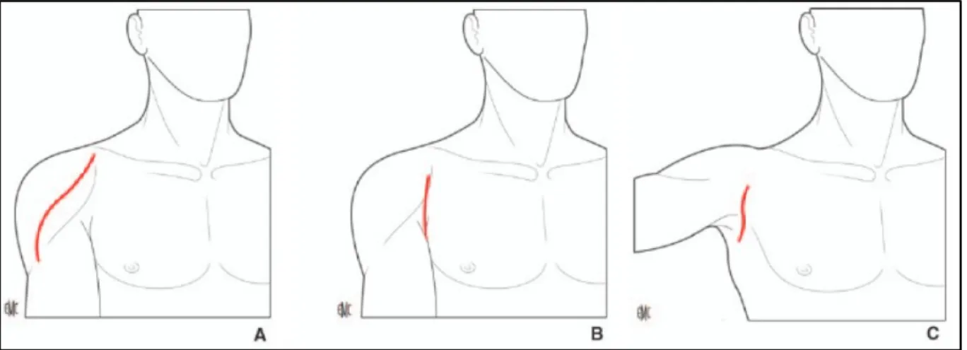 Figure   8   :   Abord   deltopectoral   classique   (A),   et   ses   variantes   antérieure   basse   (B)   et   axillaire   (C)