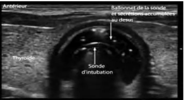 Figure  1   Coupe  transversale  du  larynx  retrouvant  un  anneau  hyperéchogène  dans  la  trachée  signant  l’intubation intra-trachéale [17]