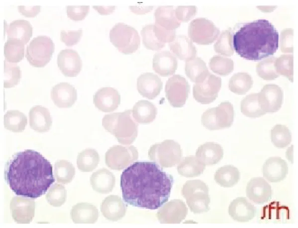 Figure 4: Leucémie aïgue lymphoblastique chez un enfant de 4 ans (F4) 