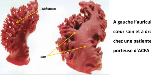 Figure 3 : Anatomie auriculaire gauche chez un patient indemne de  pathologie et anatomie auriculaire gauche chez une patiente en ACFA selon 