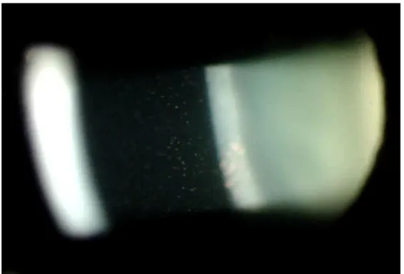 Figure 2 : effet Tyndall dans le cadre d’une uvéite antérieure photographié au biomicroscope  en  grossissement  x16  –  photographie  du  service  du  Pr  Milazzo,  Centre  Hospitalier  Universitaire d’Amiens 