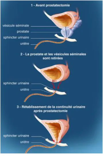 Figure 1. La prostatectomie totale (source : l’INCa) 