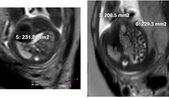 Figure 1a et 1b. Mesure des aires pulmonaires sur coupe axiale à l’IRM 