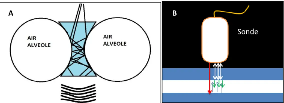 Figure 5 : Origine des artéfacts en échographie pulmonaire signant un  syndrome interstitiel :  (A) L'épaississement  des septas entre les alvéoles (œdème), piège les ondes ultrasonores et  produit  un  écho  retardataire  composé  de  multiples  échos  co