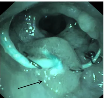 Figure 3: Follow up after nitinol stent insertion (flexible bronchoscopy): presence of a granuloma at  the proximal end of the stent in the left main bronchus