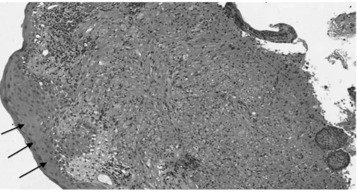 Figure 5 : Coloration HES (Hématoxyline-Eosine-Safran) d’une tumeur à cellules granuleuses bénigne  endobronchique