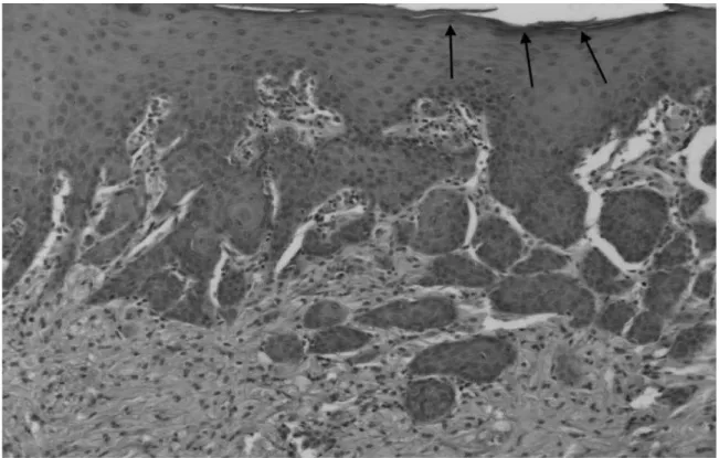 Figure 8 : Coloration HES (Hématoxyline-Eosine-Safran), grossissement x 150 : hyperplasie pseudo  carcinomateuse de l’épithélium de surface dans le cadre d’une tumeur à cellules granuleuses bénigne  endobronchique