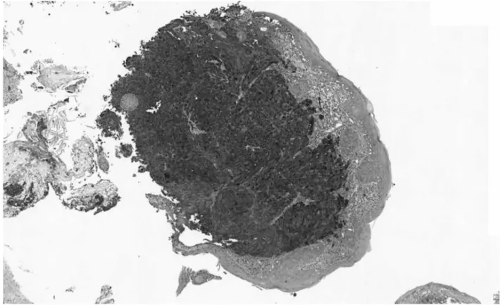 Figure 10 : Immunomarquage pour la Protéine S-100 d’une tumeur à cellules granuleuses bénigne  endobronchique