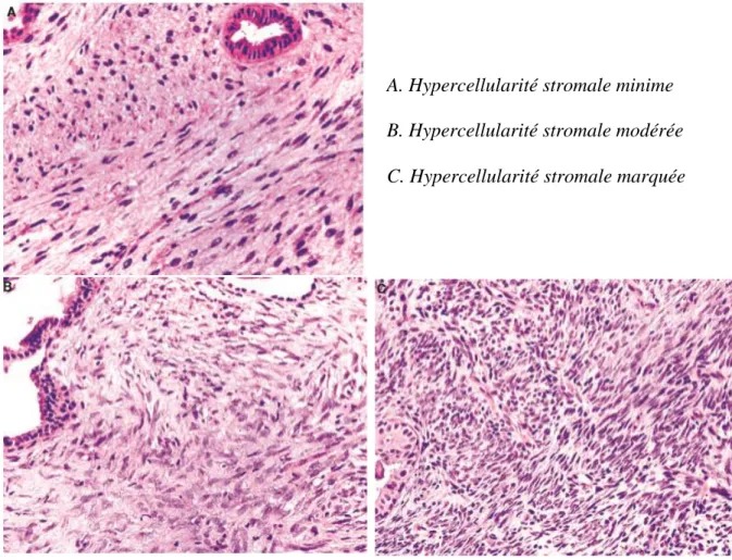Figure 7 : Aspects histologiques des différents degrés de l’hypercellularité stromale 