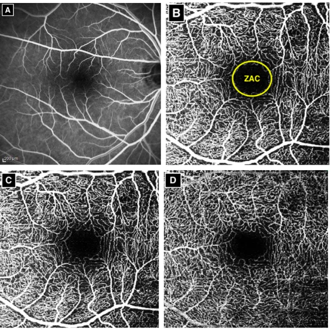 Figure  2.  Vascularisation  rétinienne.  A)  Réseau  rétinien  en  angiographie  à  la  fluorescéine