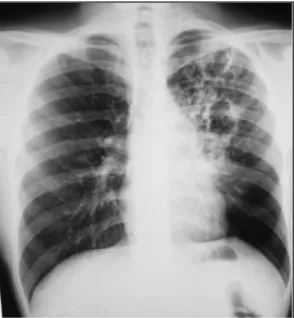 Figure 9 : Aspect de tuberculose pulmonaire avec nodules   (14) 