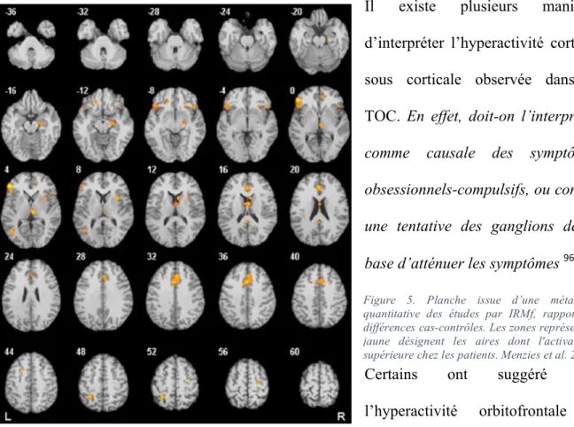 Figure  5.  Planche  issue  d’une  méta-analyse  quantitative  des  études  par  IRMf,  rapportant  les  différences cas-contrôles