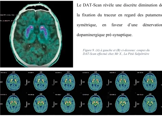 Figure 9. (A) à gauche et (B) ci-dessous: coupes du  DAT-Scan effectué chez Mr X., La Pitié Salpêtrière 