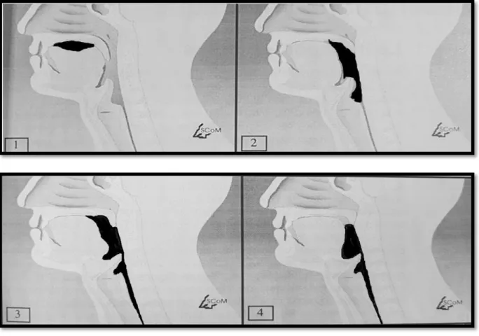 Figure 6: Différents temps de la déglutition(22) 